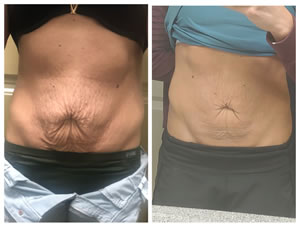 AMAZING RESULTS WITH BODY CONTOURING at Soleful Journey, Wheat Ridge, Colorado